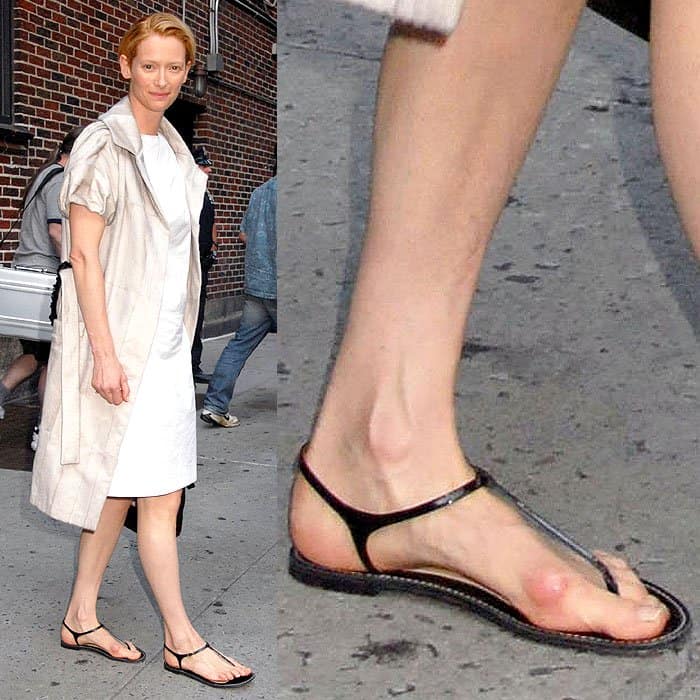 Celebrity Bunions: How to Prevent and 