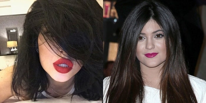 Kylie Jenners Lips Fail Before And After Plastic Surgery