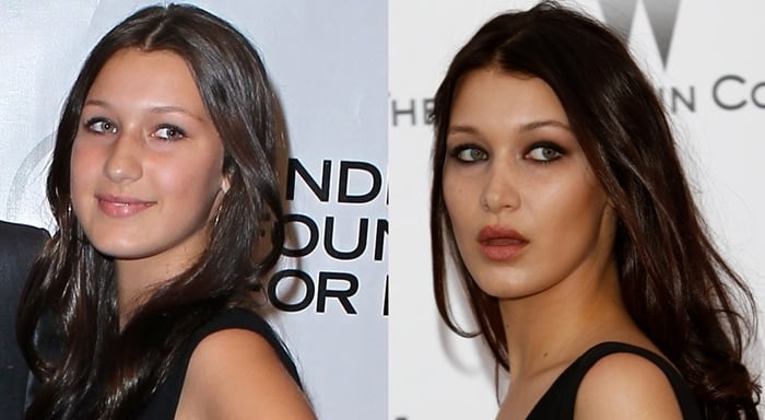 Bella Hadid's Plastic Surgery: Before and After Photos