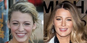 Blake Lively S Nose Job Surgery Face Before And After