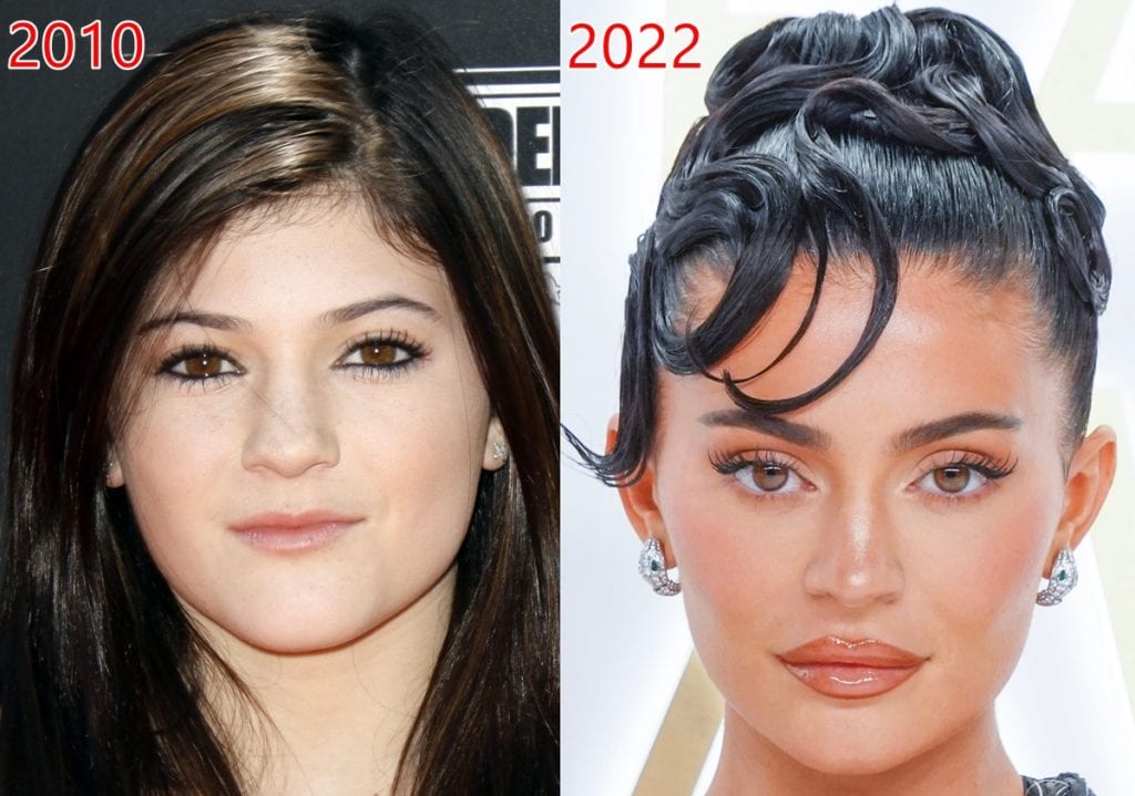 Kylie Jenner's Plastic Surgery: Face Before And After Photos